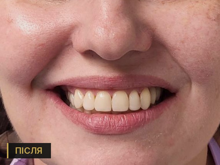Імплантація жувальних зубів та відновлення естетики — після лікування